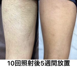 男性太もも裏　10回照射から5週間経過 TOP